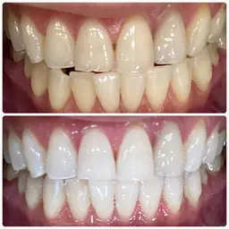 【期間限定】初回6トーンアップ！セルフホワイトニング🦷30分照射⭐️