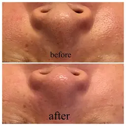 【毛穴の黒ずみ・ザラつき】水素水トルネード洗浄×ヒト幹細胞で感動の陶器肌へ【毛穴ハイドロフェイシャル&頭皮ケア】