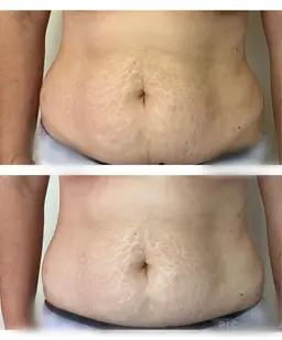 【脂肪撃退！】全身60分どこでも当て放題！脂肪＆セルライトにアプローチ✨キャビテーション&ラジオ波&EMS（筋肉運動）