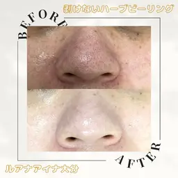 【ミニモ限定💡贅沢メニュー✨】レディース顔脱毛＋フェイシャル60分＋小鼻黒ずみハーブピーリング🌿