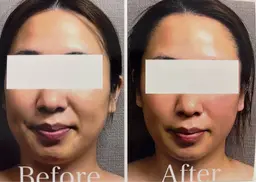 【ほうれい線】ゴルゴライン・マリオネット改善✴︎80min【¥18,700→¥8,800】