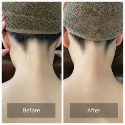 ✨おすすめ✨【3箇所セレクト脱毛】箇所の選択自由✴︎ 最新IPL×SHR ハイブリッド美肌脱毛