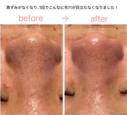 毛穴を目立たなく！ピーリング＆ハイドラ洗浄×世界特許ヒト幹細胞を使用するエレクトロポレーションで「加工いらずの艶肌」へ