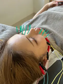 ✨オススメ✨美容鍼+ベッドスパ　むくみ/頭痛/眼精疲労¥9,300→5500