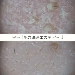 【メンズフェイシャル】皮脂ゴッソリ★毛穴洗浄 ヘッドスパ付