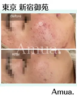 【初回選べるハーブ】毛穴・頭皮洗浄付きハーブ 🌿ソフトorハード