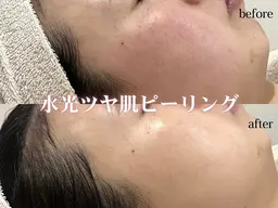 【毛穴レスピーリング】ラミネーションピール×カーボキシー