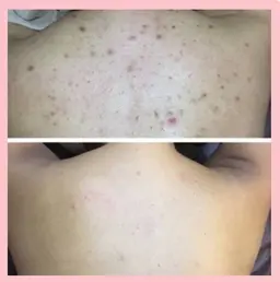 Bodyハーブピーリング🌿(ハード剥離あり)背中、腰、二の腕、お尻、デコルテ等🩵吹き出物、毛穴のザラつき、色跡に🩵