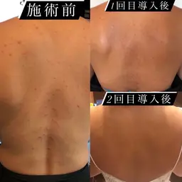 【背中・腕/ニキビケア/ハーブピーリング】ザラ肌改善◎3g体験