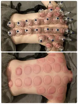 【毒素排出❤️‍🔥体内の老廃物を排出】デトックスカッピング🙆‍♀️🪄🙆‍♂️60min⏳