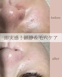 つるんとタマゴ肌✨ピーリング力UP！美肌コース