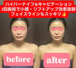 【小顔特化】ハイパーナイフ＆キャビテーションフェイシャル60分