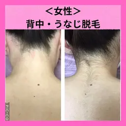 【女性脱毛】実は見られている!うなじ&背中似合わせシェービング付き