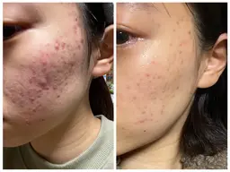 <フェイシャル>小顔、ツヤ肌へ✨エイジングスペシャルコース