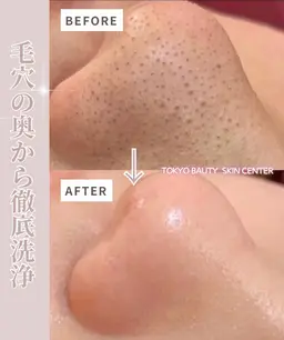 【再来】【毛穴の奥から徹底洗浄】毛穴フェイシャル&PDRN美白液導入保湿水光肌へ