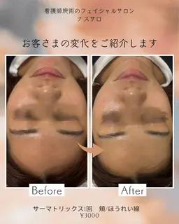 ⭐️リフトアップ効果実感/お試し価格⭐️【サーマトリックス/オリジオ同様効果】✔️1パーツのみ​〜​施術したい部位追加可能​〜​