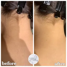 🉐◎12月限定◎【背中ニキビケア/毛穴】 背中全体＋うなじ脱毛 ￥14960⇒¥5980