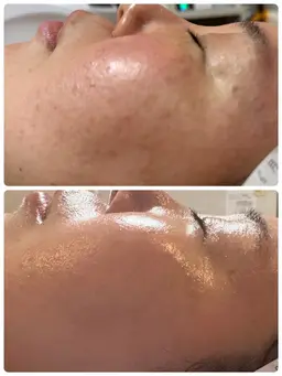 お手軽エステ　毛穴掃除付き　ツルツル美肌コース　生コラーゲン塗布付き♪　初回価格\3900