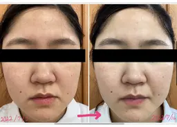 潤い美白フェイシャル3回プログラム