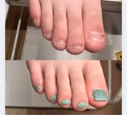 【新規様限定】フット🦶深爪矯正/オシャレを楽しみながら深爪矯正〜ワンカラー仕上げでお爪の長さ出し