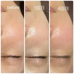 人気No.2! ペプチド研究者監修!肌育ピーリング☆ラミネーションピール✨60min