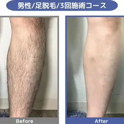 ☆メンズ脱毛☆夏前には足がツルツル♪足全脱毛3回コース　24000円⇒18000円