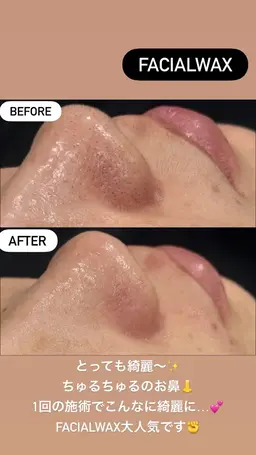 【新春お年玉】部分Wax+毛穴洗浄+LED肌管理パック ¥6,800→¥5,800