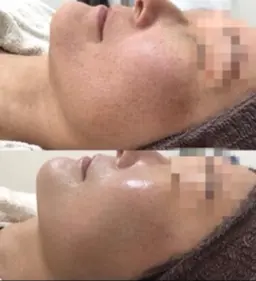 皮膚科学に基づいたハーブピーリング 🌿