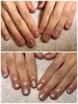 深爪矯正8990円→6990円