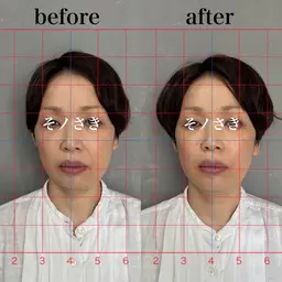 ⭐️お試し美容鍼（約20本）＋通電＋小顔矯正60分コース🔥先着3名🔥口コミ割✨ 初回ご来店の方のみ可✨