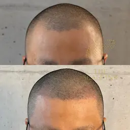 スカルプインクで男性も女性もは薄毛対策に！小顔効果絶大！半永久的に薄毛とはおさらば！できます