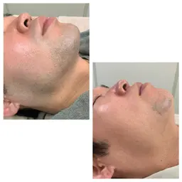 顔脱毛(髭脱毛）