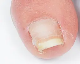 【巻き爪】B/Sブレイス 両親指(オフなし)