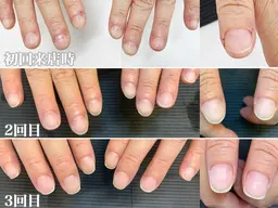 《1回でも見た目の劇的変化あり✨》定期的な来店で深爪矯正のメニューです◎オフなし、オフ込みも同価格