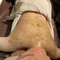 ブライダルにも✨背中、二の腕のぶつぶつトラブル改善🌟【ハーブピーリング】背中全体＆二の腕トリートメント