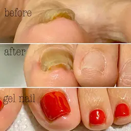 【オフ無し】両親指巻き爪矯正•ジェルネイルワンカラー仕上げ