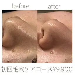 《人気No.1》フェイシャル毛穴ケア60分