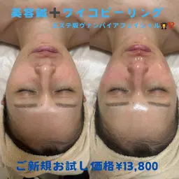 美容鍼➕WiQo®️ワイコ水光ピール