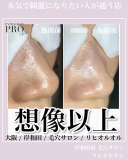 【新規】当店1番人気‼️《美肌デコルテコース＋肌リセットダブルケア🌿》毛穴洗浄とデコルテマッサージでお肌集中ケア✨️