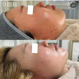 【国内最高濃度ピーリング】韓国美肌/肌質シミ改善/ニキビケア16800→14800