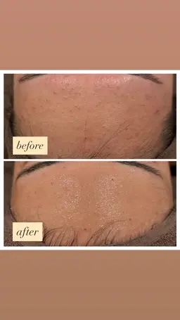 【12月限定メニュー🎅🏻🎄】小顔ハイパーナイフEX+REVIハーブピーリング🌿(ヘッドマッサージ付き)