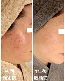 【潤いツヤ肌】セラピール+血流リンパマッサージ+美容液導入　70分