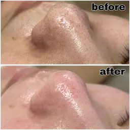 【毛穴汚れ・ざらつき撃破!】毛穴洗浄シェービング