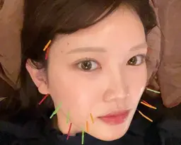 超お得🉐材料費のみ💡小顔鍼の練習モデル募集❣️むくみ・たるみを整え、フェイスラインすっきりを体感しませんか？