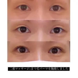 切らずに二重✨ダブルアイリフト