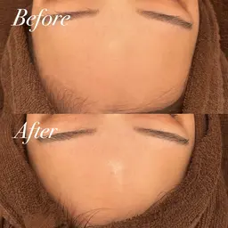 【当日予約限定❗️お得◎】ハイドラフェイシャル+リジュランピール🫧　艶々の水光肌に✨