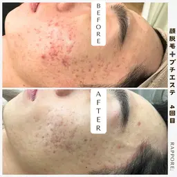 【毛穴汚れ撃退✨】メンズ♡顔脱毛+プチエステ付き