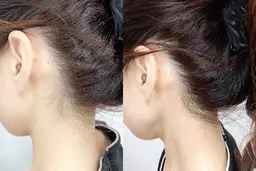 【うなじor襟足WAX脱毛】ブライダルね方にも人気♪