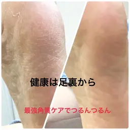 一度でわかる!大好評の角質ケア🌸機械でつるつる✨足の角質ケア