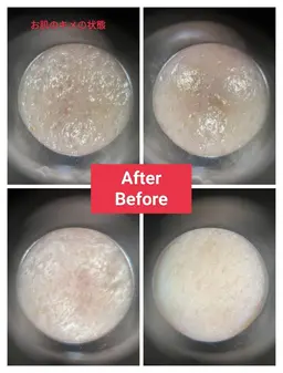 一回のエステで小顔に！エイジングケアエステ